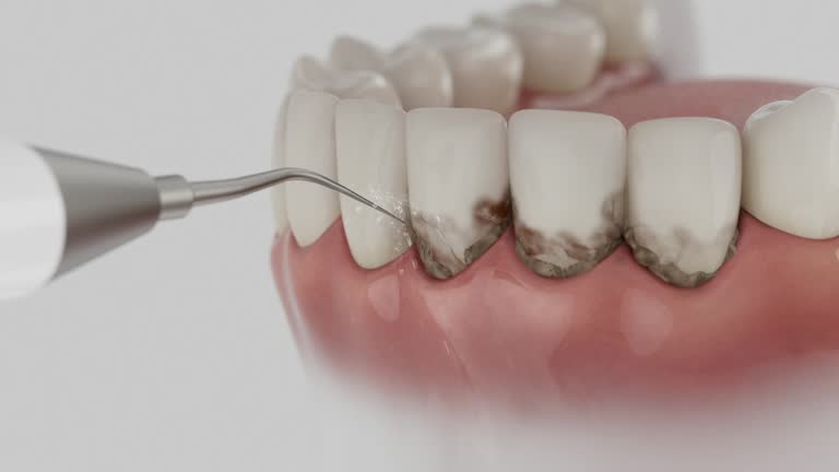Trusted Wisdom Tooth Removal service in Elbow Lake, MN - Dentist Open Now